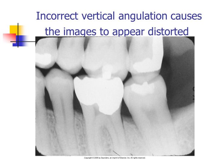 The result of incorrect vertical angulation